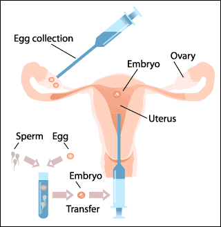 How does in vitro fertilization work?